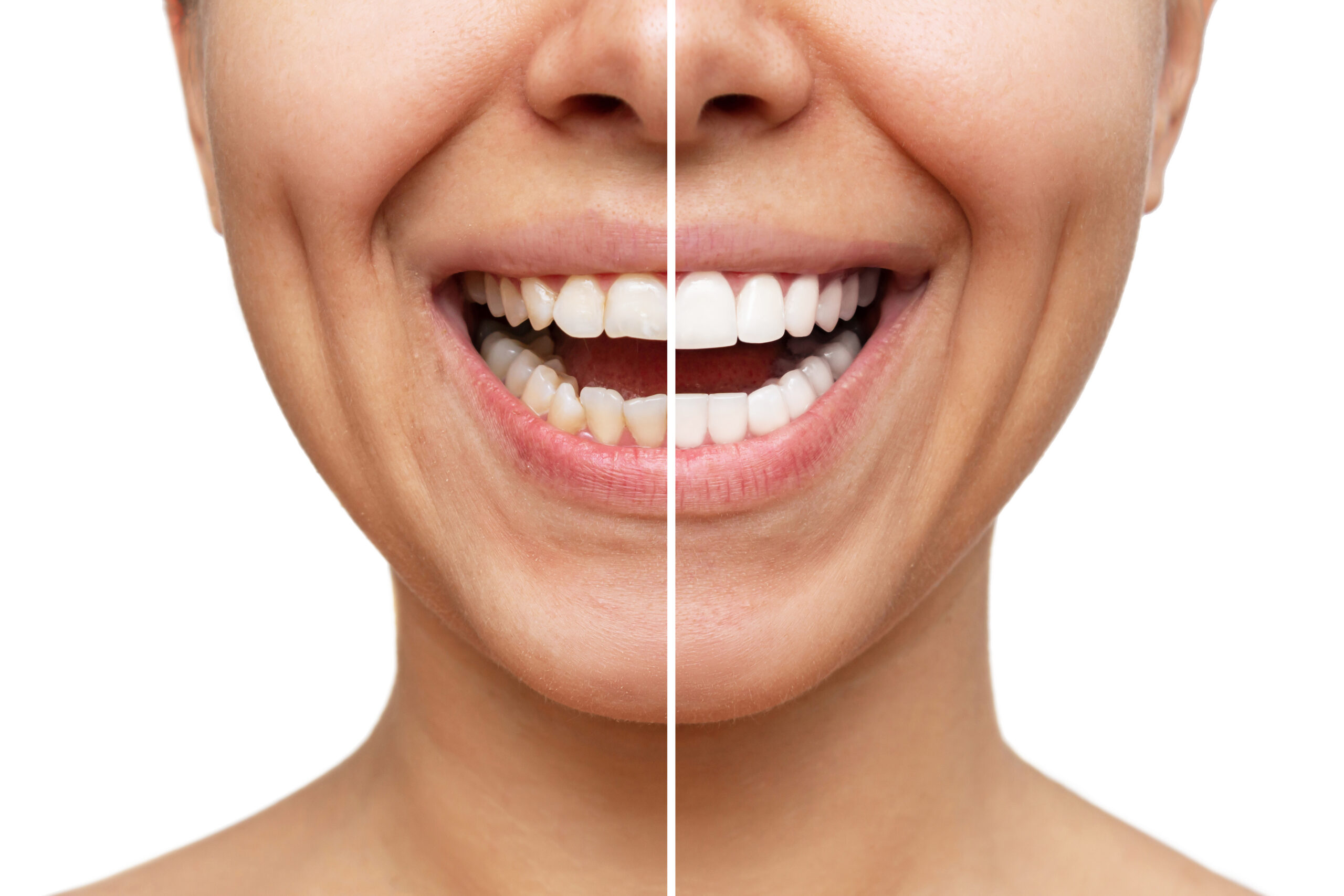 Titelbild zu „Veneers Türkei: Strahlendes Lächeln für Selbstvertrauen“