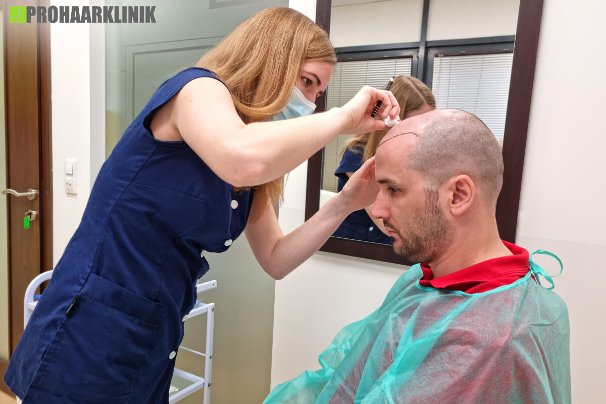 Titelbild zu „Haartransplantation kosten für Männer: Ist es in Ungarn oder im Ausland günstiger?“