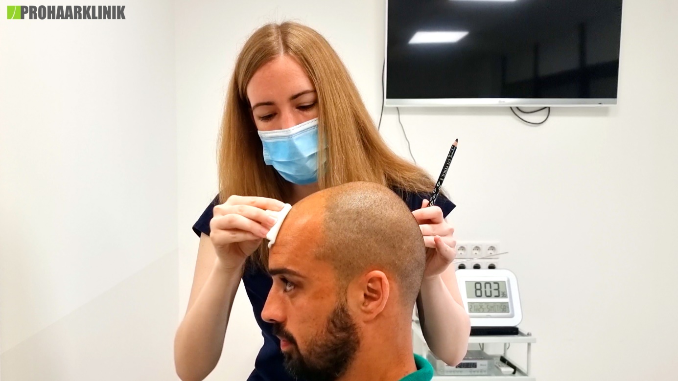Titelbild zu „Die 6 häufigsten Fragen und Antworten vor einer Haartransplantation“