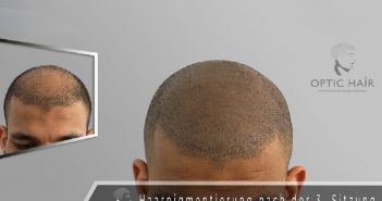 Haarpigmentierung in Berlin bietet eine natürliche Lösung bei Glatzenbildung