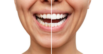 Veneers Türkei: Strahlendes Lächeln für Selbstvertrauen